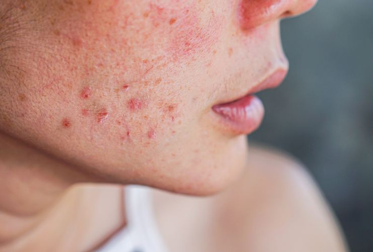 Dieta per una pelle senza acne